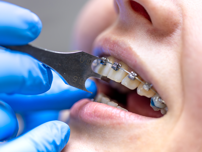 Ортодонт и остеопат: зачем ходить сразу к двум специалистам при неправильном прикусе