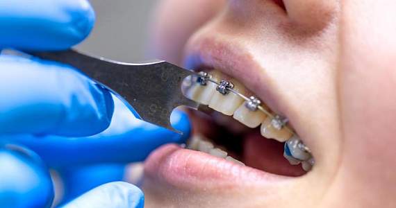 Ортодонтия без потерь: скрытые последствия удаления зубов, о которых вам не расскажет стоматолог