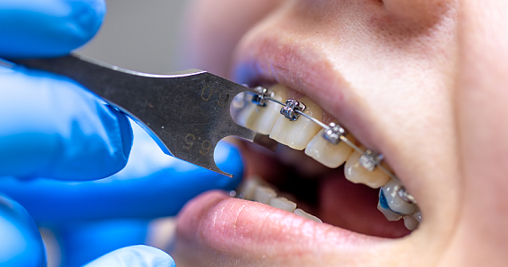 Ортодонт и остеопат: зачем ходить сразу к двум специалистам при неправильном прикусе 